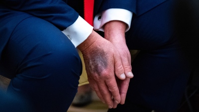 Βόμβα Express: «Ο Trump βρίσκεται στα πρώτα στάδια της άνοιας, έπαθε εγκεφαλικό και κάνει θεραπείες»