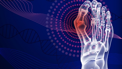 Βλαισός μέγας δάκτυλος (κότσι): Διόρθωση με διαδερμική τεχνική τρίτης γενιάς στο Metropolitan Hospital