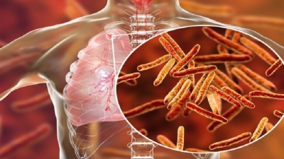 Αυξάνεται ο αριθμός των νεκρών από φυματίωση στη Ευρώπη σύμφωνα με τον ΠΟΥ