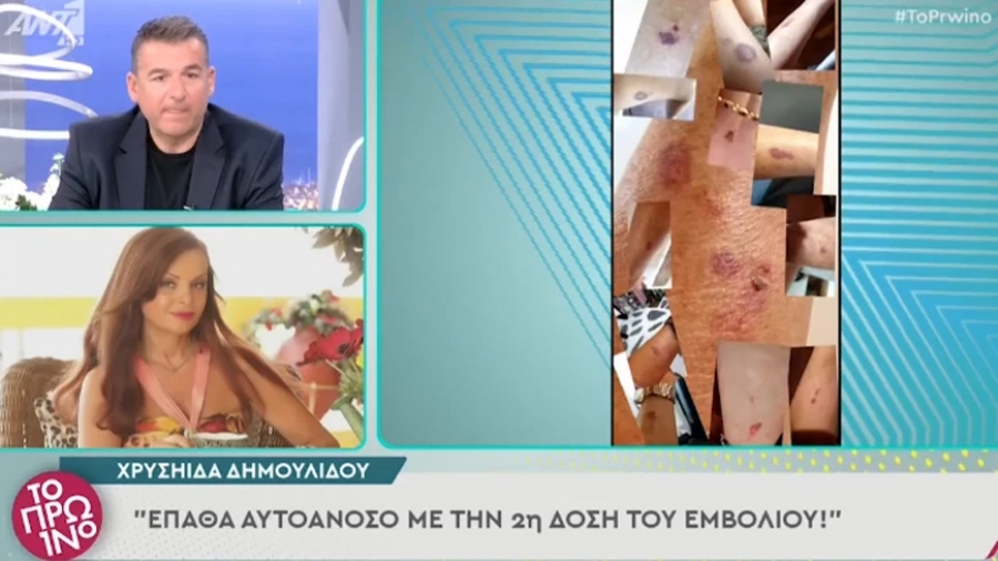 Χρυσηίδα Δημουλίδου: Έκανα 2η δόση του εμβολίου και έπαθα λύκο - «Πτώση μαλλιών, εξανθήματα, κούραση, μύριζα καπνό»