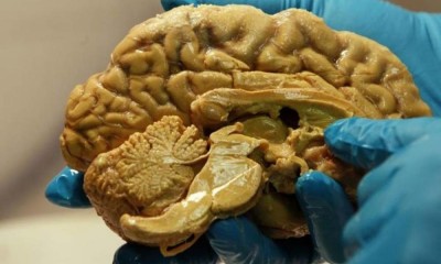 ΗΠΑ: Σε συναγερμό κομητεία του Τέξας μετά τον θάνατο 6χρονου από αμοιβάδα που τρώει τον εγκέφαλο