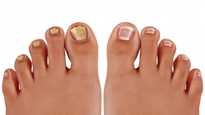 Ονυχομυκητίαση: Ένα μικρό πρόβλημα με μεγάλο χρόνο θεραπείας