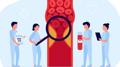 Αθηροσκλήρωση: Οι εξελίξεις στη φαρμακευτική αντιμετώπισή της