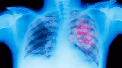 Στερεοτακτική Ακτινοθεραπεία Πνεύμονα: Ριζική λύση χωρίς χειρουργείο