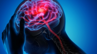 Ενδοαγγειακή Νευροχειρουργική για αντιμετώπιση βλαβών του εγκεφάλου