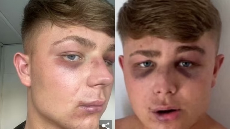Ζάκυνθος: «Με έστειλαν στο νοσοκομείο για μία selfie», λέει ο Βρετανός τουρίστας που ξυλοκοπήθηκε από μπράβους