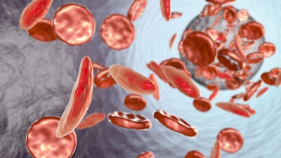 Αναιμία: Aιτίες, συμπτώματα και αντιμετώπιση