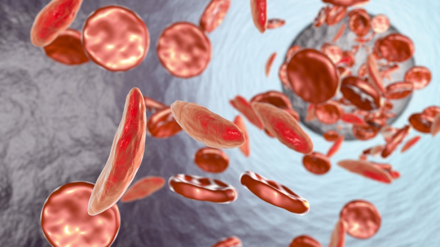 Αναιμία: Aιτίες, συμπτώματα και αντιμετώπιση