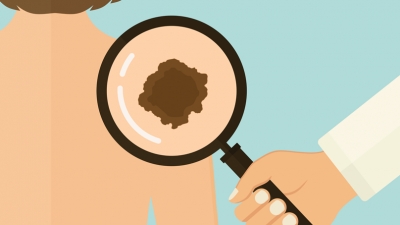 Νέα μέθοδος αντιμετώπισης προχωρημένου σταδίου σαρκώματος/μελανώματος