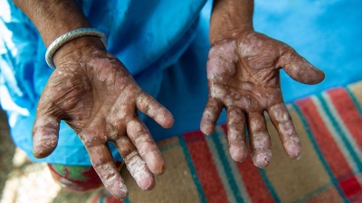 Συναγερμός στη Ρουμανία - Εντοπίστηκαν κρούσματα λέπρας