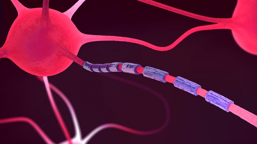 Σκλήρυνση κατά Πλάκας: Τι είναι και πώς αντιμετωπίζεται