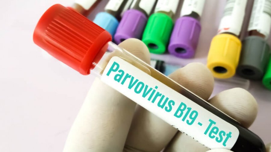 Παρβοϊός: Συμπτώματα, διάγνωση και αντιμετώπιση