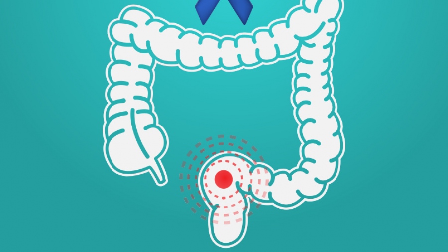 Σύγχρονες μέθοδοι αντιμετώπισης καρκίνου του ορθού