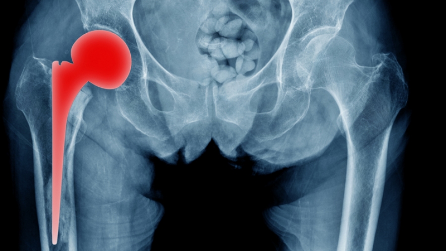 SuperPATH: Αποτελεσματική τεχνική για ολική αρθροπλαστική ισχίου