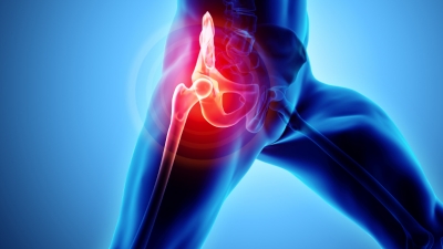 Πόνος στο ισχίο: Ένα συχνό, σύνηθες αλλά και ύπουλο σύμπτωμα