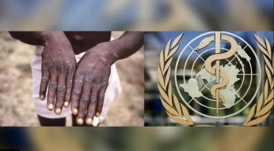 ΠΟΥ: Η αναζωπύρωση της ευλογιάς των πιθήκων δεν συνιστά κατάσταση έκτακτης ανάγκης