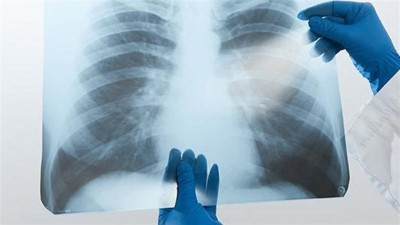 Πνευμονία: Πρόληψη, διάγνωση και θεραπεία