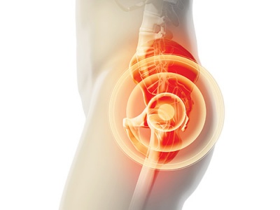 Ολική αρθροπλαστική ισχίου με τη μεθοδο AMIS