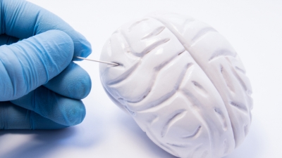 Μηνιγγίωμα εγκεφάλου: Τι είναι και πώς αντιμετωπίζεται