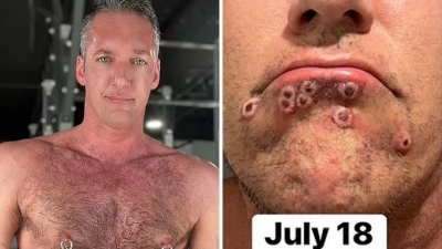 Γκέι πορνοστάρ δείχνει τις φρικτές φουσκάλες ως αποτέλεσμα της ευλογιάς των πιθήκων που κόλλησε