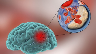 Διακαθετηριακή αντιμετώπιση ανευρυσμάτων