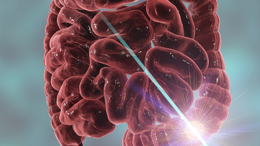 Καρκίνος παχέος εντέρου και ορθού: Οι σύγχρονες θεραπείες