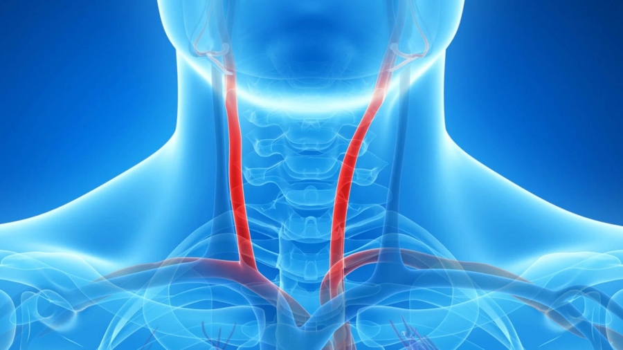 Στένωση καρωτίδας και εγκεφαλικά επεισόδια