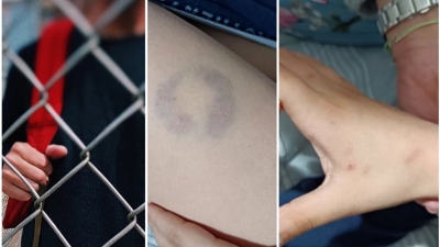 Παρέμβαση του υπουργείου Παιδείας για το απίστευτο περιστατικό στην Άρτα - Διευθύντρια σχολείου δάγκωσε 11χρονο μαθητή ΑμεΑ