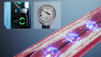 Ενδοστεφανιαία λιθοτριψία: Σύγχρονη αντιμετώπιση στεφανιαίων βλαβών