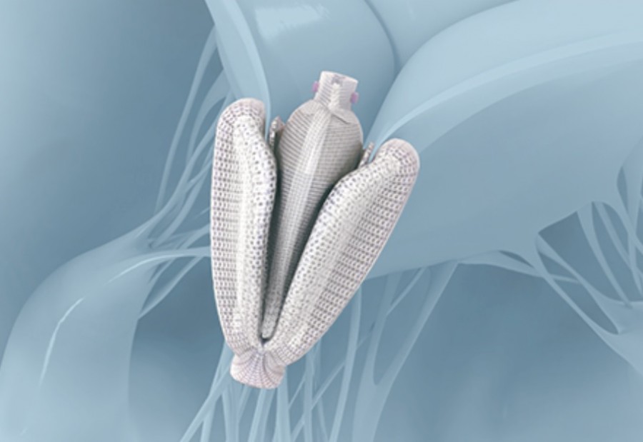 ΥΓΕΙΑ: Νέες θεραπευτικές δυνατότητες για τη θεραπεία ασθενών με πρόβλημα στην τριγλώχινα βαλβίδα της καρδιάς