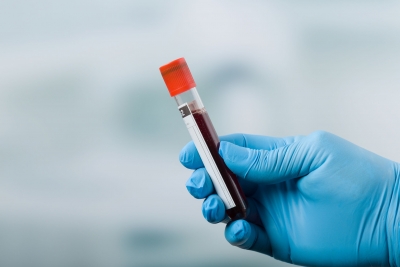 Nέο τεστ αίματος ανιχνεύει περισσότερα από 50 είδη καρκίνου πριν τα συμπτώματα – Αρχίζει η μεγαλύτερη παγκοσμίως δοκιμή