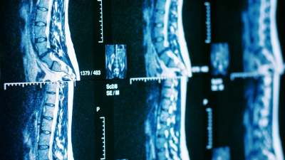 Ρομποτική χειρουργική σπονδυλικής στήλης: Τα πλεονεκτήματα