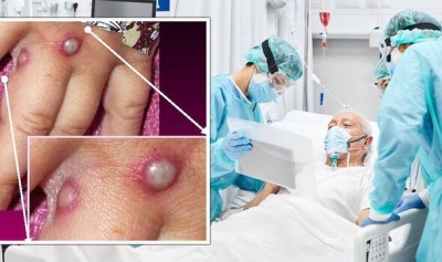 Έρχεται νέο... εμβόλιο; O αμερικανικός FDA ενέκρινε φάρμακο για τη θεραπεία της ευλογιάς των πιθήκων - Τρόμος σε ΗΠΑ, Ευρώπη