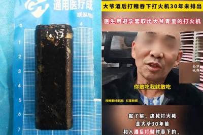 Γιατροί αφαίρεσαν έναν αναπτήρα από το στομάχι άνδρα που το είχε καταπιεί πριν από... 30 χρόνια