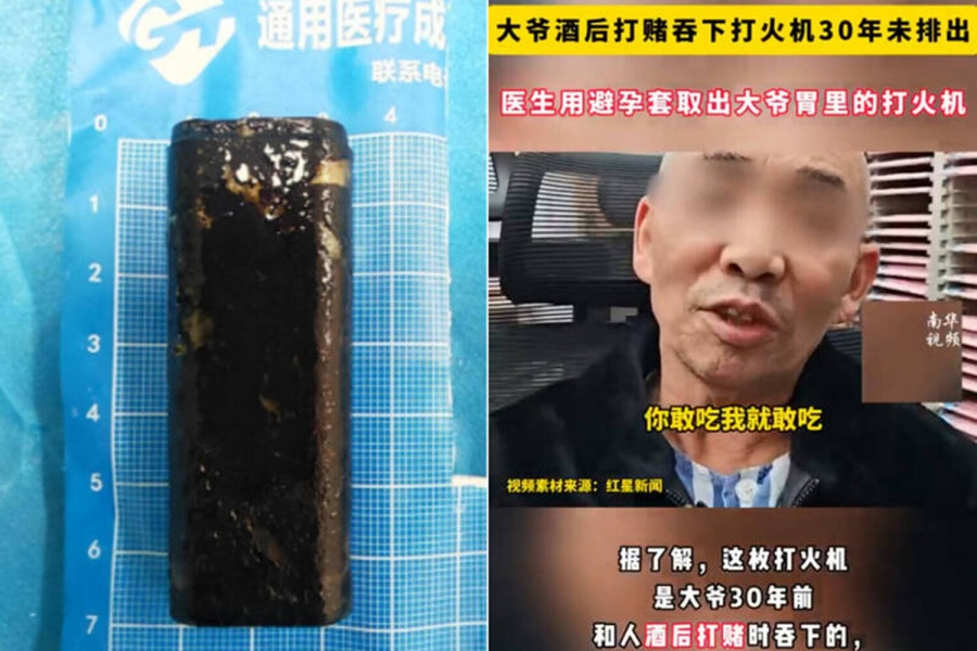 Γιατροί αφαίρεσαν έναν αναπτήρα από το στομάχι άνδρα που το είχε καταπιεί πριν από... 30 χρόνια