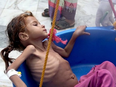 ΟΗΕ: Σε πρωτόγνωρα επίπεδα ο υποσιτισμός παιδιών στην Υεμένη