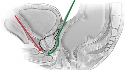 Σύγκριση ρομποτικής ριζικής προστατεκτομής με τη λαπαροσκοπική ριζική προστατεκτομή