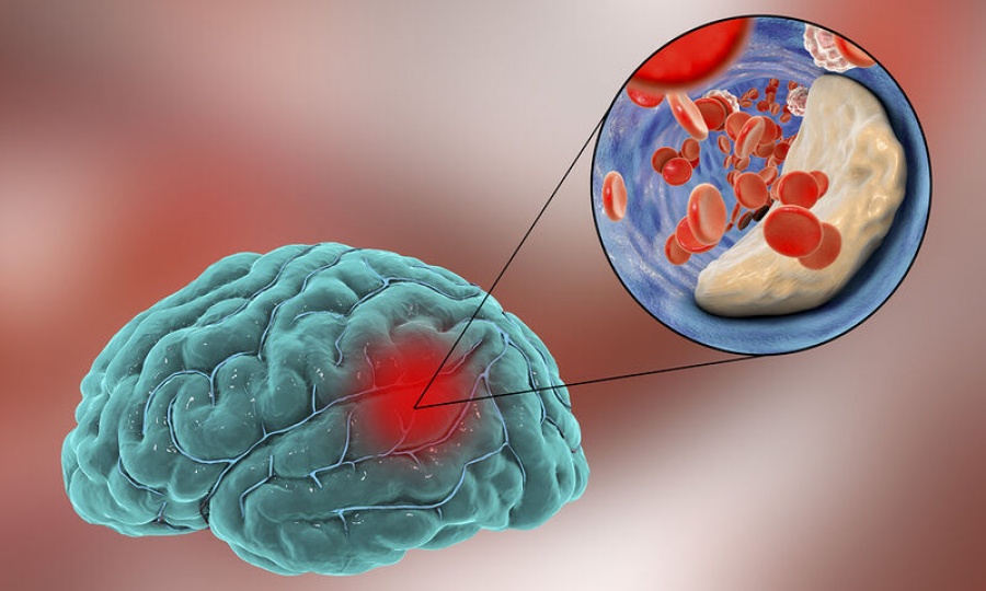 Εγκεφαλικά Ανευρύσματα: Σύγχρονες χειρουργικές και ενδαγγειακές τεχνικές