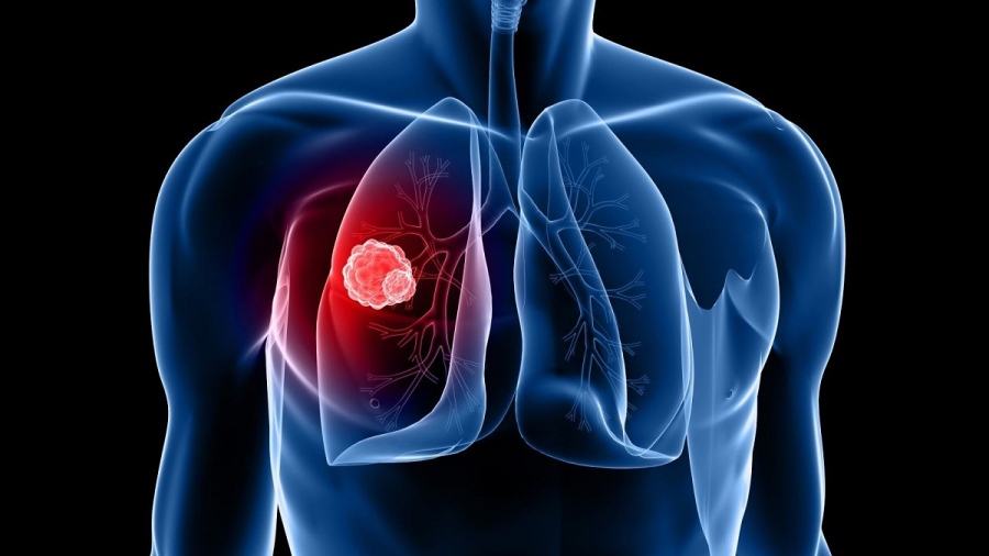 Καρκίνος του πνεύμονα - Η σημασία της ενημέρωσης και της έγκαιρης διάγνωσης