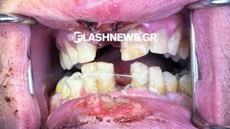 Εξερράγη ηλεκτρονικό τσιγάρο στο στόμα άνδρα στο Ηράκλειο - Σοκαριστικές εικόνες - Άρπαξαν φωτιά μέχρι οι κουρτίνες