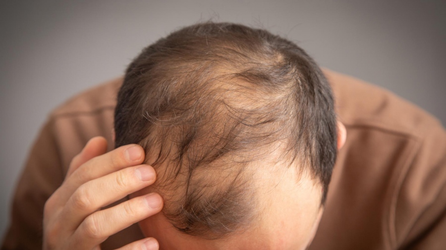 Επιστημονική ανατροπή - Νέα μοριακή ανακάλυψη αποκαλύπτει το «σημείο μηδέν» της τριχόπτωσης