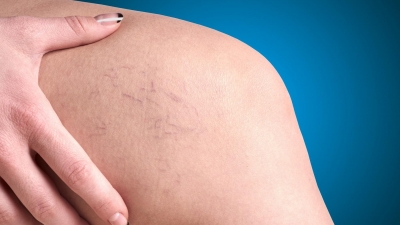 Ευρυαγγείες: Τι είναι και πώς θα απαλλαγείτε