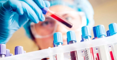Νέο τεστ αίματος προβλέπει με ακρίβεια τον κίνδυνο εμφράγματος και εγκεφαλικού