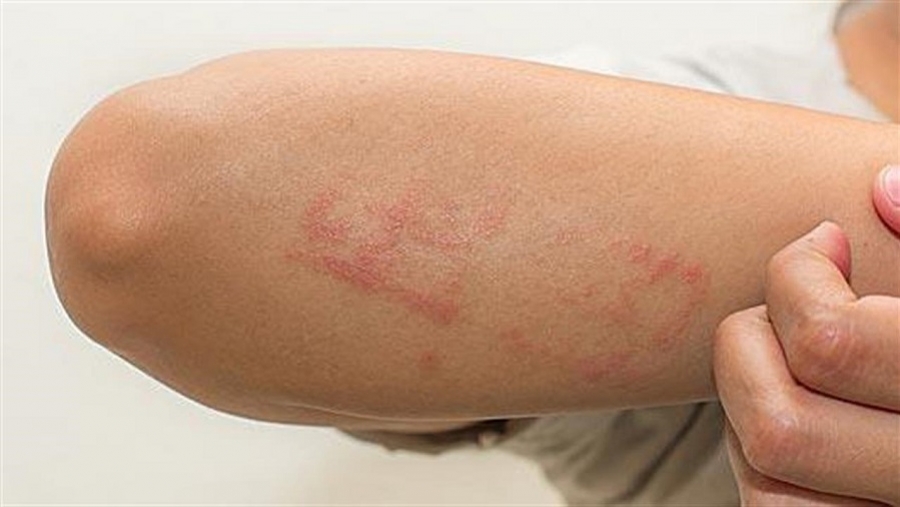 Ατοπική δερματίτιδα - Η συχνότερη χρόνια δερματοπάθεια των παιδιών