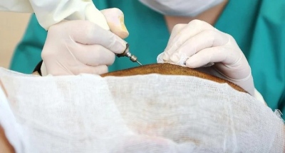 Καταρρέει ο μύθος των «καλών επιστημόνων» - Νέο σοκαριστικό δυστύχημα στην Τουρκία, νεκρός Βρετανός μετά από μεταμόσχευση μαλλιών