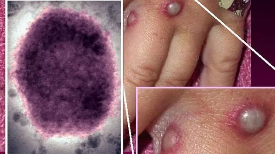 Η νέα πανδημία; Και στις ΗΠΑ ο ιός της ευλογιάς των πιθήκων - Μεταδόθηκε από άνδρες που κάνουν σεξ με άλλους άνδρες