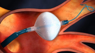 Cryoablation: Νέα μέθοδος αντιμετώπισης όγκων μαστού χωρίς χειρουργείο