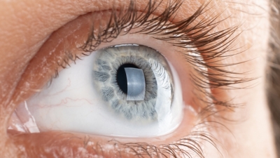 Κερατόκωνος: Επιπτώσεις και τρόποι αντιμετώπισης