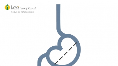 ΙΑΣΩ Γενική Κλινική: Δωρεάν Χειρουργικές Επεμβάσεις για την αντιμετώπιση της Νοσογόνου Παχυσαρκίας από την Β΄ Χειρουργική Κλινική