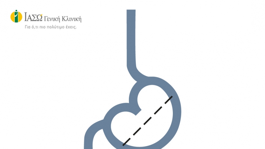 ΙΑΣΩ Γενική Κλινική: Δωρεάν Χειρουργικές Επεμβάσεις για την αντιμετώπιση της Νοσογόνου Παχυσαρκίας από την Β΄ Χειρουργική Κλινική
